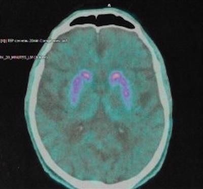 Late-Onset OCD as a Potential Harbinger of Dementia With Lewy Bodies: A Report of Two Cases